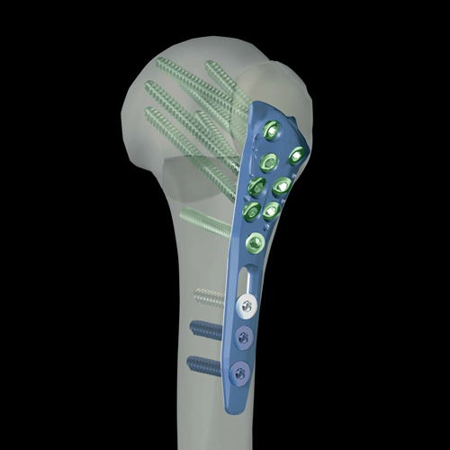 Alians-Proximal-Humerus